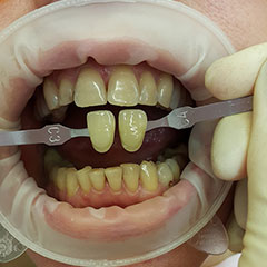 отбеливание на несколько тонов отбеливание на несколько тонов